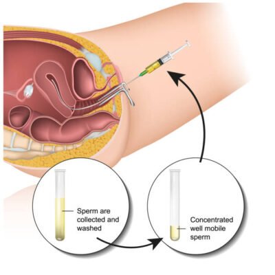 IUI- How To Best Prepare For It?